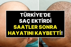 ingiltereden-turkiyeye-sac-ektirmeye-gelen-hasta-ameliyat-sonrasi-hayatini-kaybetti-7dXyjiZB.jpg